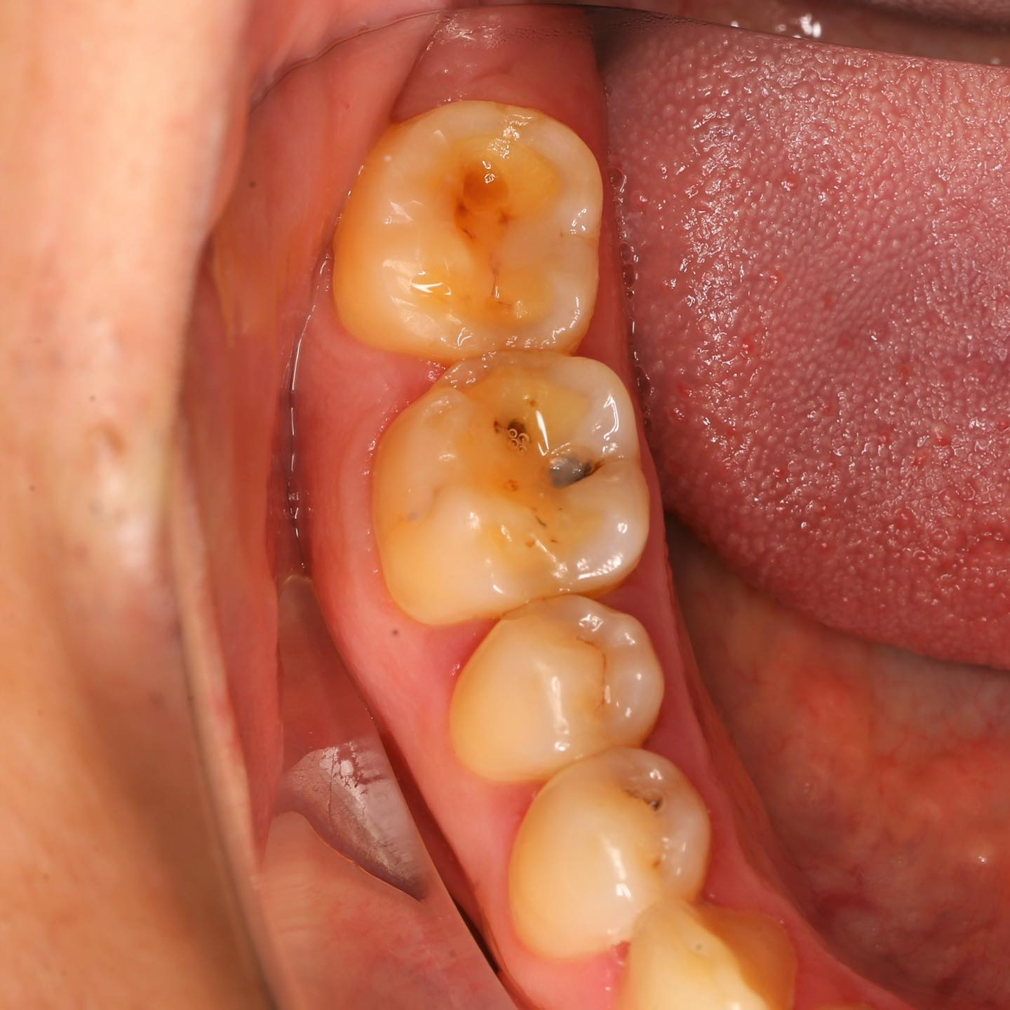 Xử lý thế nào khi răng bị mòn nhiều?