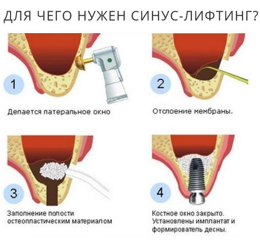 Синус-лифтинг - популярная операция в челюстно-лицевой хирургии 