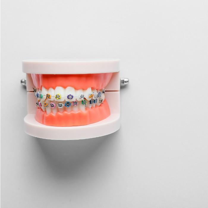 Overbite braces