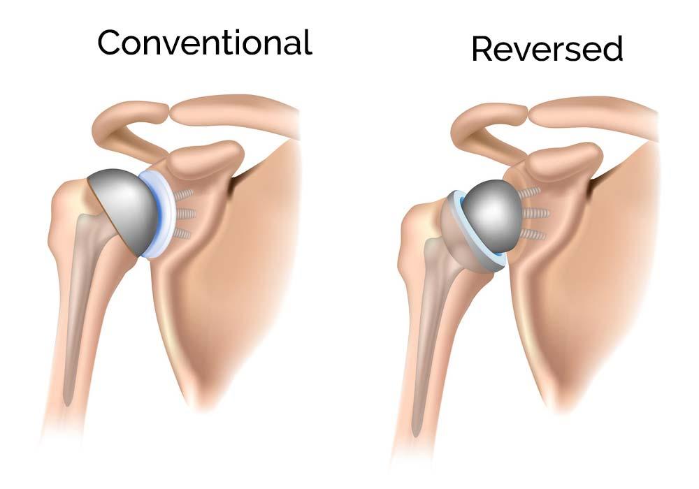 Reverse Shoulder Arthroplasty | Shoulder Surgery | Shoulder Arthroscopy in  Bangalore