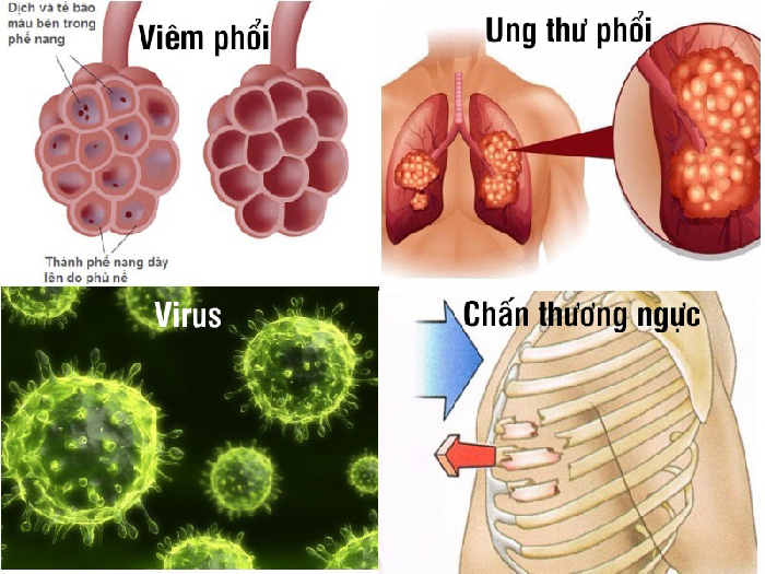 Nguyên nhân của bệnh tràn dịch màng phổi