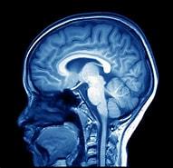 Image result for MRI Scan Of the Brain. Size: 191 x 185. Source: theodc.net
