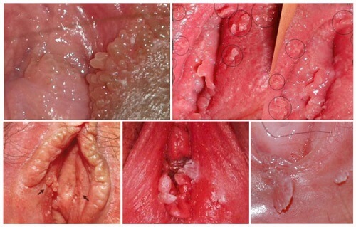 Papilloma virus condilomi - Cum se vindecă papilomele pe buze - Cu condilomi imunitari
