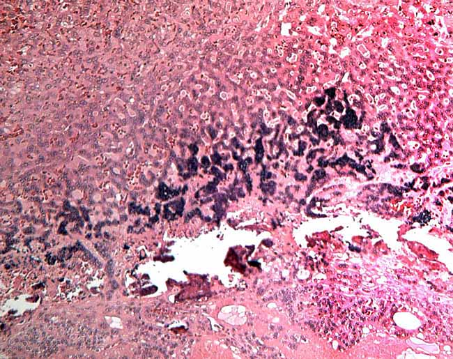 Basal portion adjacent to subplacenta with giant cell infiltration of fibrin and degenerating debris.