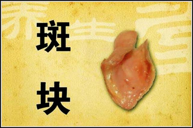 专家：血管老化和去除动脉粥样硬化斑块的方法 - 閒靜 - √