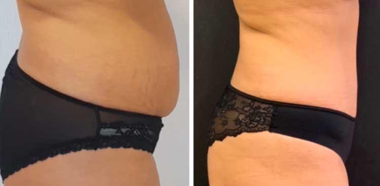 https://www.bodyexpert.online/wp-content/uploads/2021/11/blog-abdominoplastie-avant-apres-06.jpg