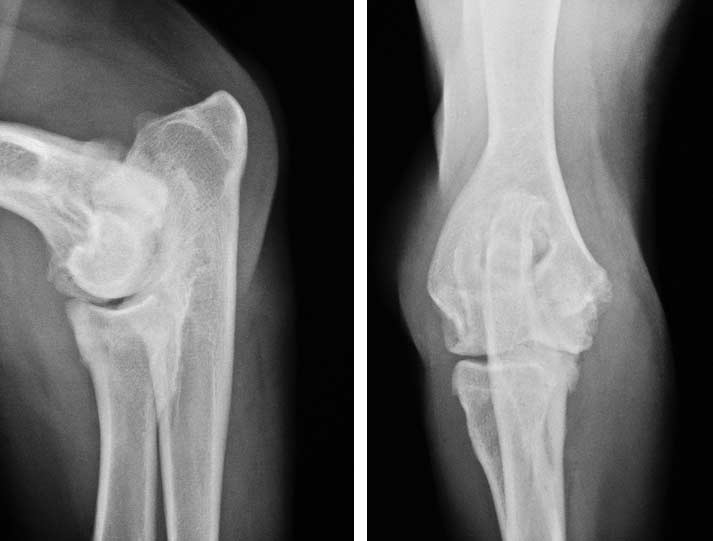 Elbow joint of an 8-month-old Bernese Mountain Dog with severe osteoarthrosis (OA). (A) Notice osteophytes at the radial head, anconeal process and medial epicondyle and osteosclerosis in the semilunear notch. (B) The craniocaudal view shows that the radial head does not run parallel with the distal humerus indicating elbow incongruity as well as an indication of a fragmented coronoid process (FCP). The final diagnosis is: elbow incongruity and FCP with severe OA. (© HAW Hazewinkel).