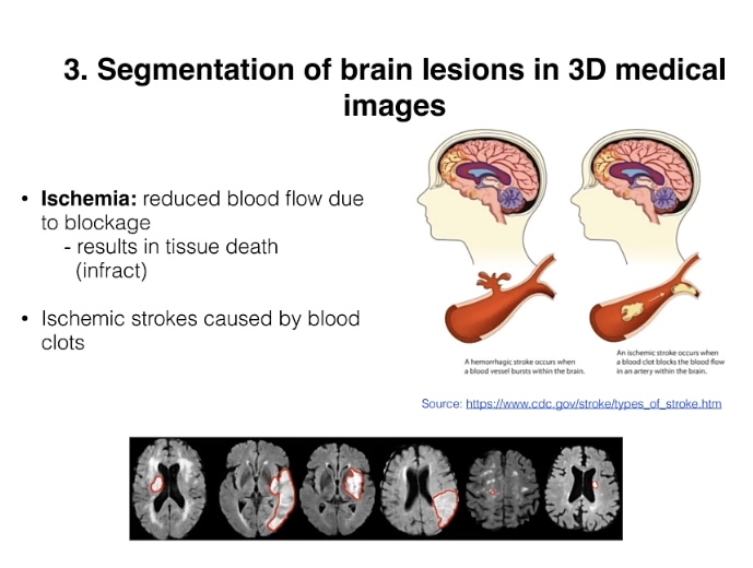 Segmenting brain lesions and 3D medical images 