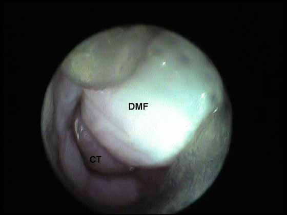 El tubérculo cervical (CT) puede verse en la distancia bajo el pliegue dorso-medial (DMF)