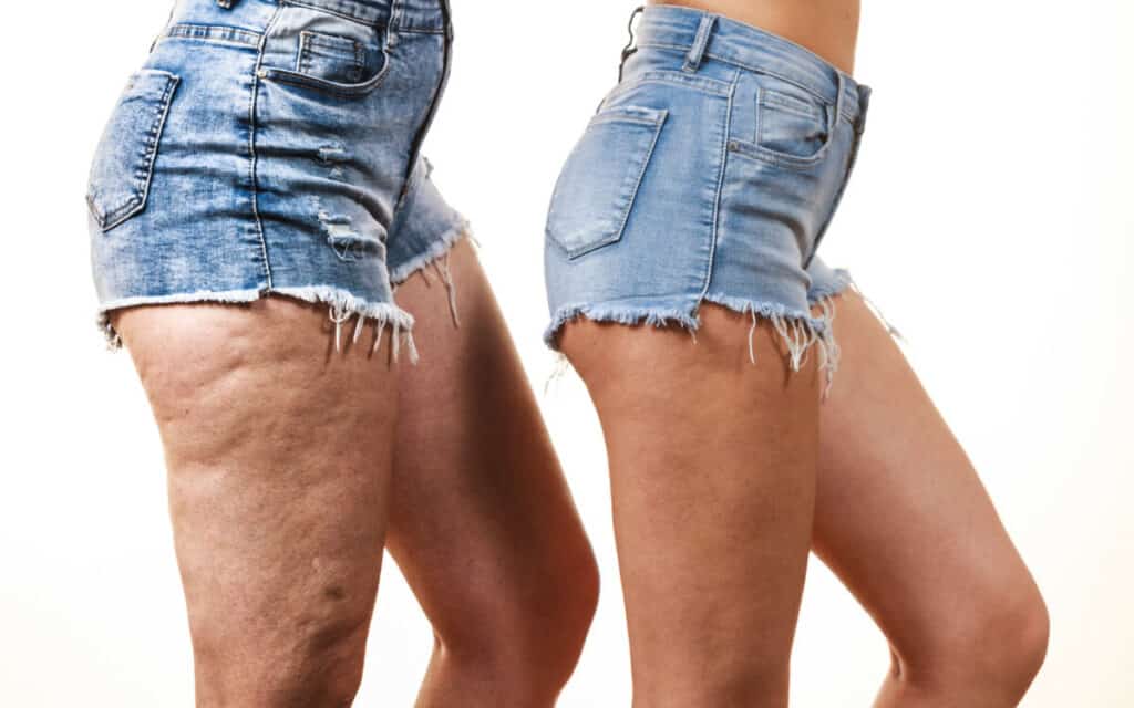 comparison of legs with and without cellulite