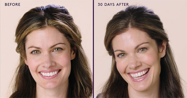 How Long Does Botox Last Around Eyes