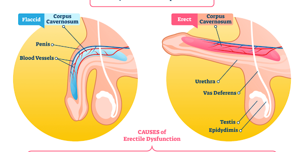    Common Causes of Impotence Myths, history, and bad old cures for erectile dysfunction