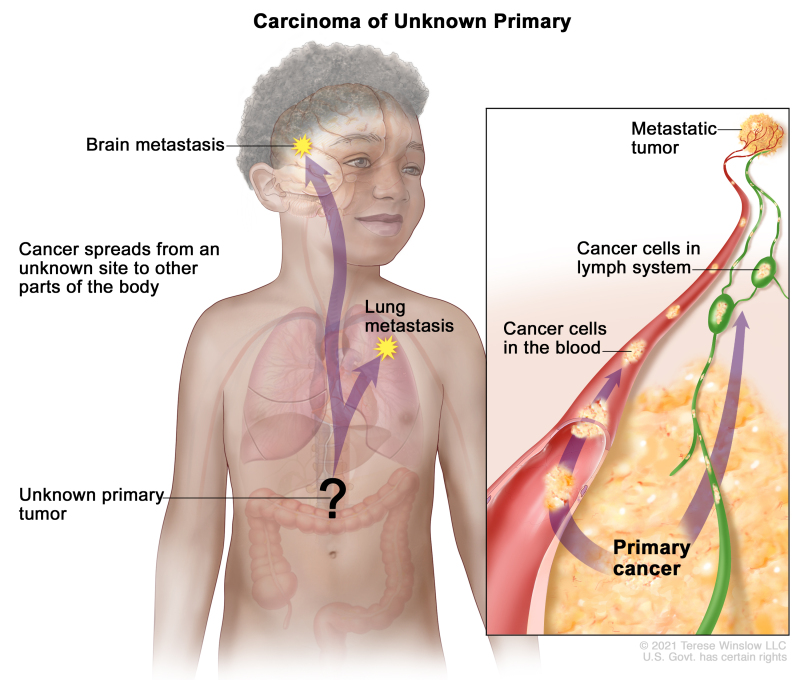 Cancer of unknown primary