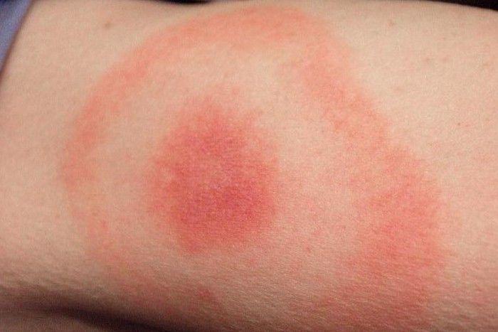 This is the classic lyme disease rash. Its known as the bulls eye rash. | Lyme  disease symptoms, Lyme disease, Lyme
