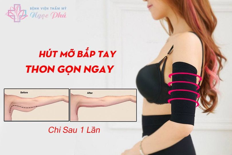 thẩm mỹ hút mỡ bắp tay là một trong những dịch vụ được chị em săn đón bởi hiệu quả mang lại bắp tay thon gọn nhanh chóng.