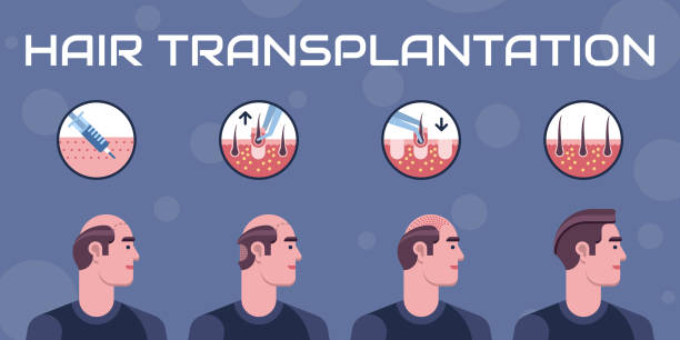 Hair Transplant Treatment in Delhi