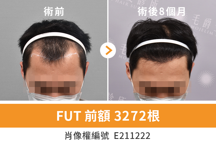 FUT植髮：免剃髮、隱痕縫合、巨量植髮