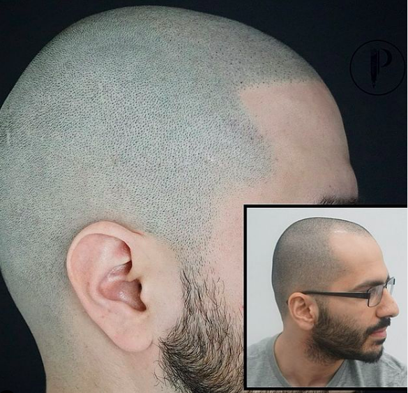 Man with bald head