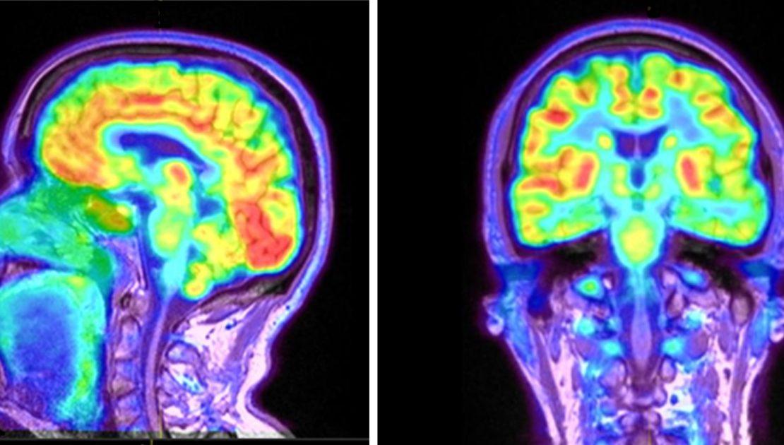 PET CT Scan Get Cost, Purpose, Side Effects & Proven Benefits [2024]