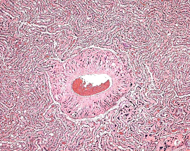 Large maternal vessel surrounded by trophoblastic giant cells