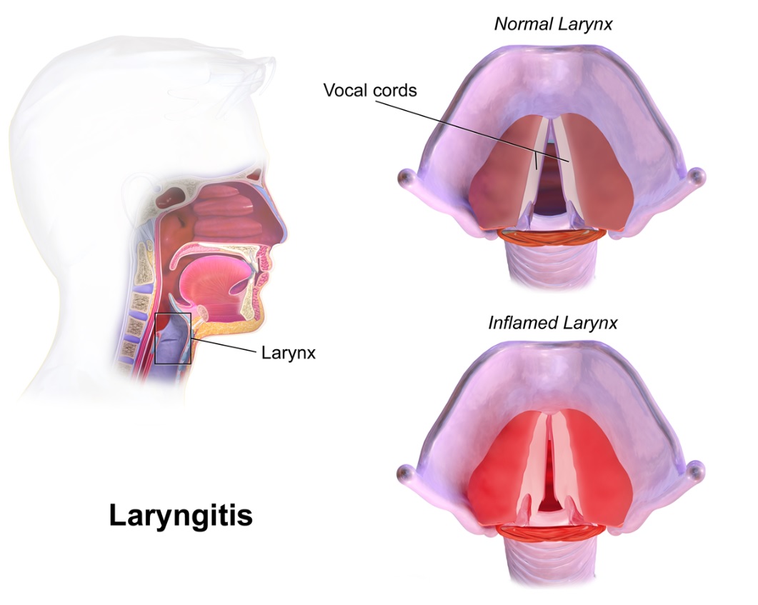 A graphic illustration showing the look of an inflamed and normal larynx and vocal chords