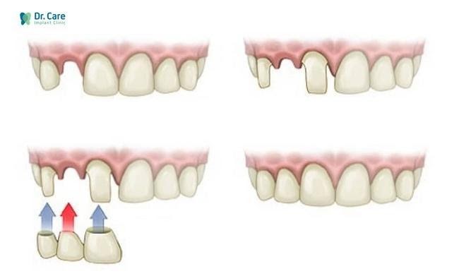 cầu răng sứ được thực hiện như thế nào