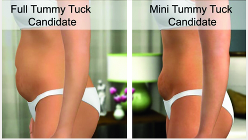 Mini Tummy Tuck Surgery Service in Ahmedabad, Chandkheda by RJ Laser Skin &  Slimming Center | ID: 19614759855