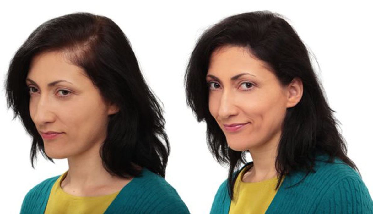 A Quick Guide for Female Hair Loss Treatment - Mommyswall