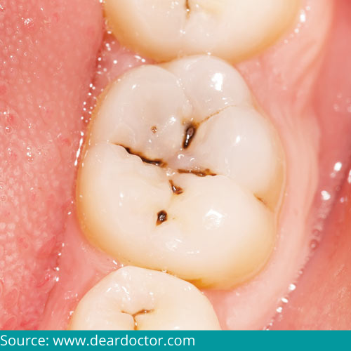 D:\Digicore\UNOSEARCH\Dr. Suhrab Singh\Most Common Dental Problems\Source cavity.jpg