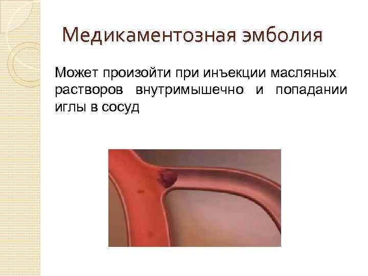 Медикаментозная эмболия