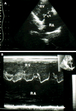 Ecocardiograma transtorácico bidimensional (ETT 2D) e imagens no modo M mostrando uma válvula tricúspide normal