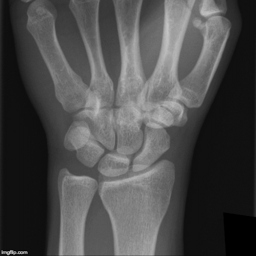 EMRad: Radiologic Approach to the Traumatic Wrist