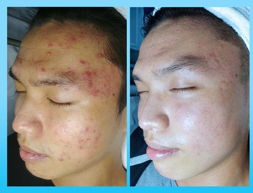 Da mụn của Thành Thái đã cải thiện được 85%, không còn mụn viêm và thâm đỏ, da sáng và đều màu hơn.