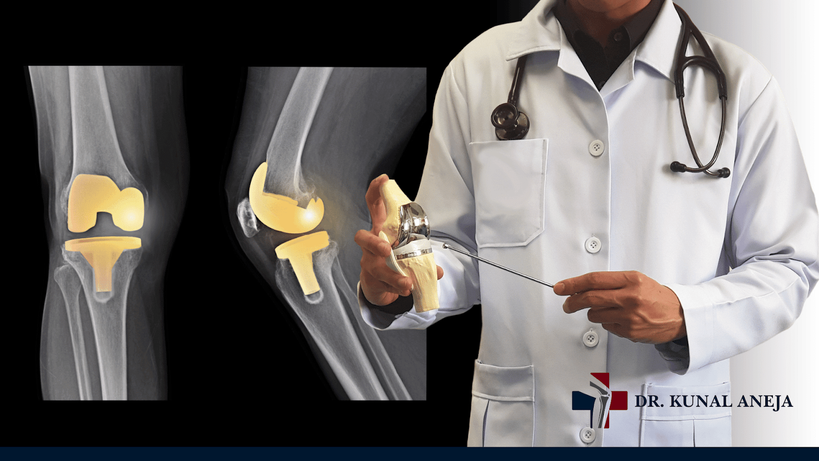 Knee Replacement in Delhi | Surgery Details & Recovery