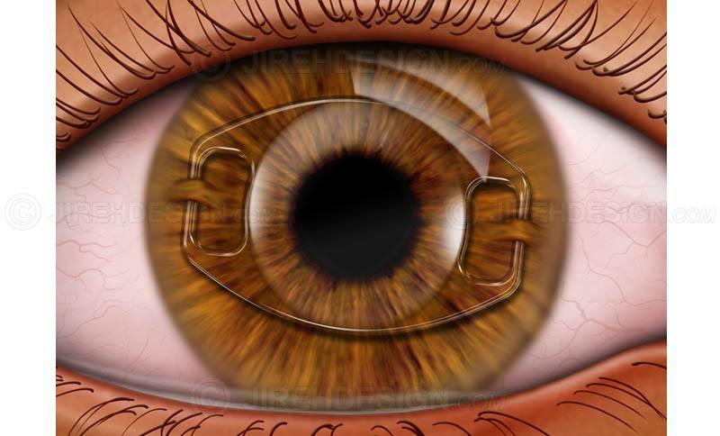 Iris fixated AC IOL - #SUI0012 - Stock eye images