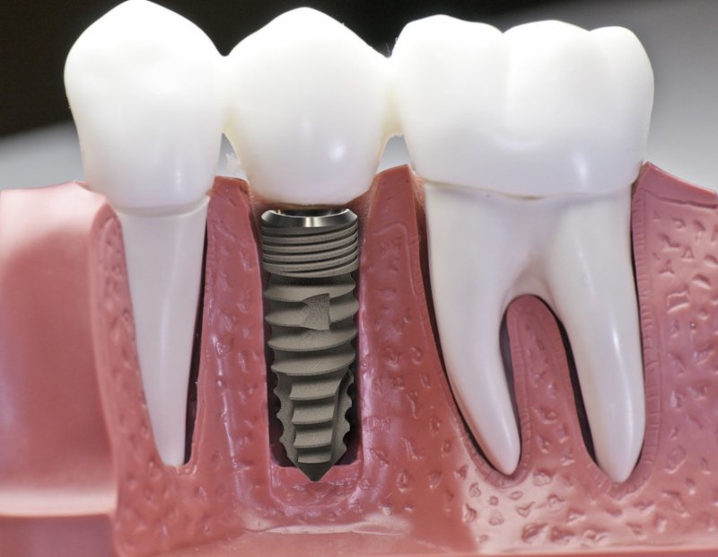 Răng Implant có khả năng thay thế răng thật đảm bảo chức năng ăn nhai