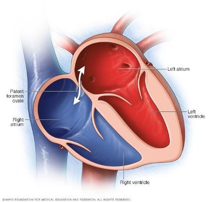 Patent foramen ovale - Symptoms and causes - Mayo Clinic
