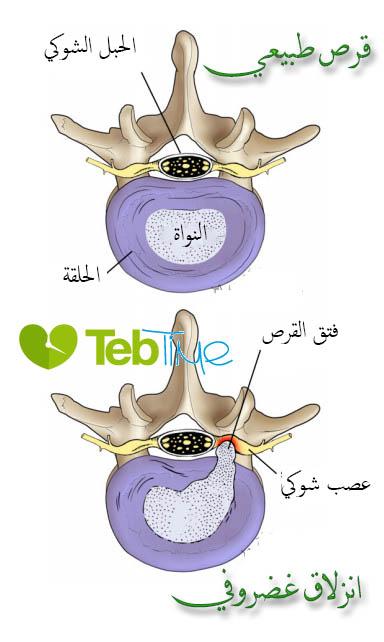 صورة توضيحية بين قرص طبيعي وانزلاق غضروفي