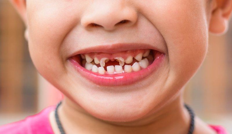 Sâu răng lâu ngày dẫn đến răng bị gãy vỡ