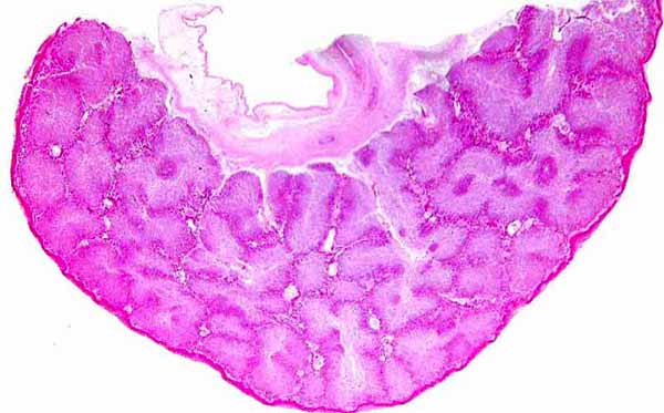 This is a cross section of the placenta that was attached to the immature aborted fetus shown first. The lobular nature of the placenta is obvious. There is no subplacenta in this specimen. The fetal surface is above.