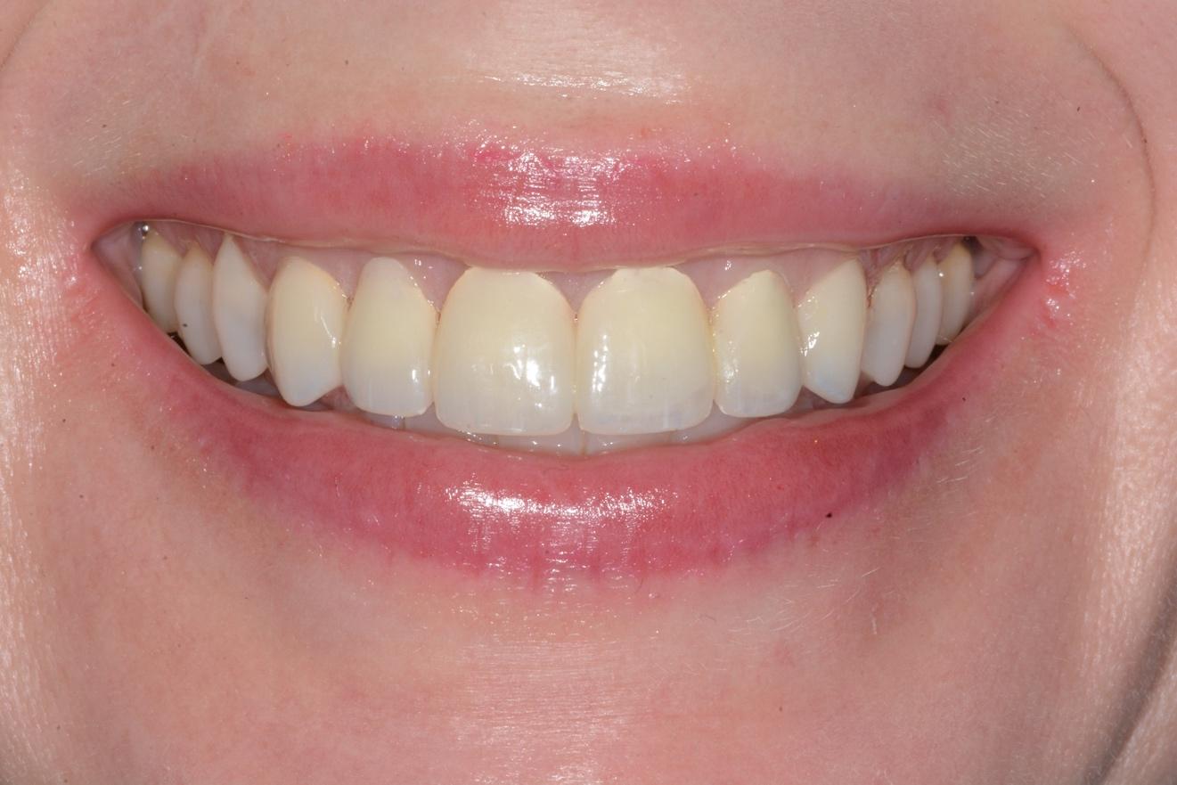 Close-up of a person's lips with teeth showing  Description automatically generated with low confidence