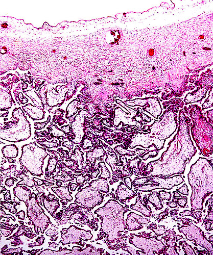 Immature placental surface of delivered (detached) placenta with larger villi.