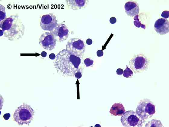 BAL cytology showing lymphocytes (arrows) from BAL. Wright-Giemsa stain. Magnification: 1000X.