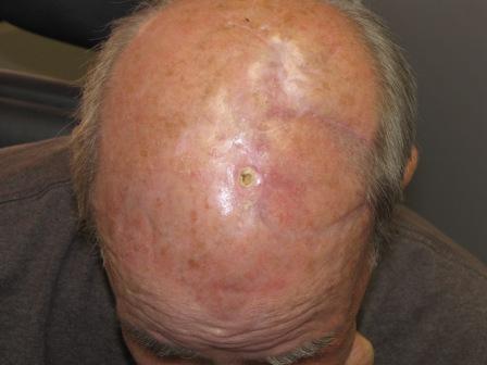 Scalp Radiation