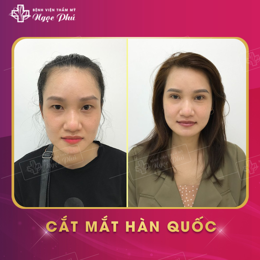 Khách hàng thực tế nâng mũi tại Thẩm Mỹ Việt Nam
