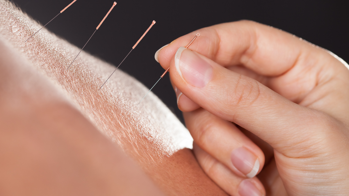 What Is Acupuncture?