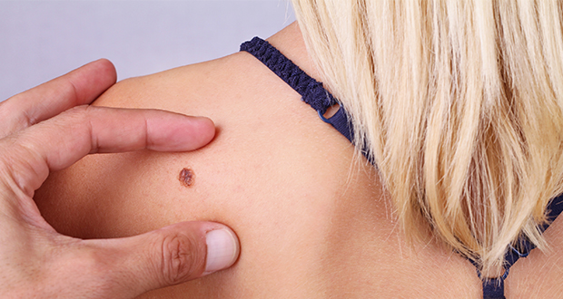 http://cancer-treatment-madurai.com/types-of-cancer-melanoma.php