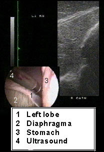 Laparoscopía ultrasonográfica del hígado izquierdo en un pony en estación.
