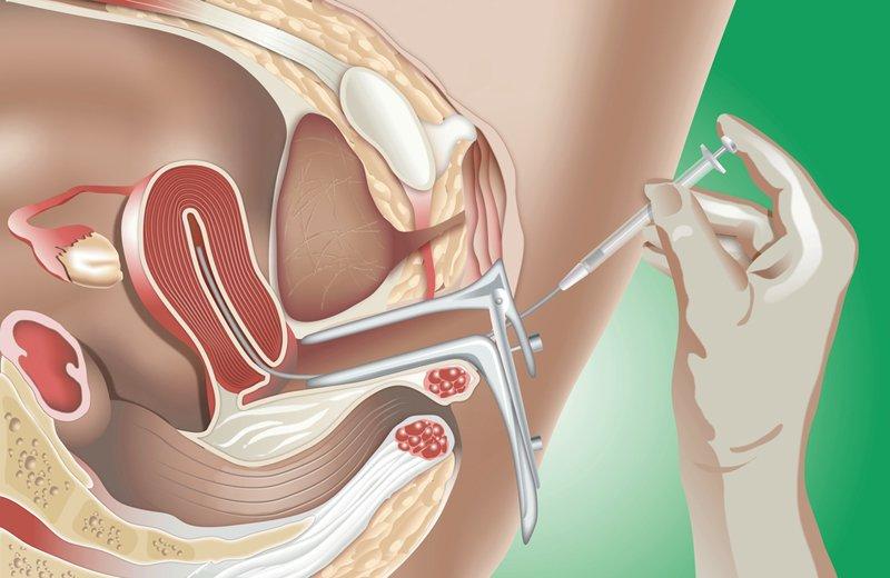 Cận cảnh quá trình bơm tinh trùng vào tử cung để mang thai, chỉ tốn 5-10  triệu tại Việt Nam