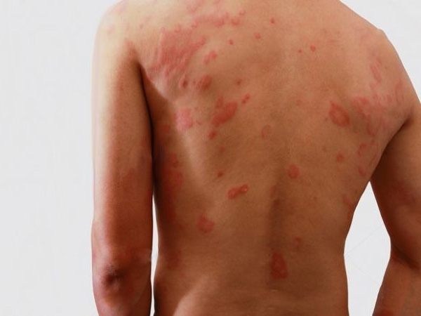 Nguyên nhân bị hắc lào ở háng Nguyên nhân bị hắc lào ở háng